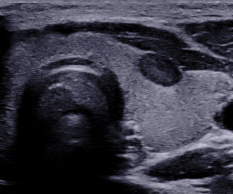 Hiperplasia nodular en paciente de sexo masculino de 15 años. Corte transversal en glándula tiroides, donde se visualiza imagen nodular homogénea, hipoecoica y de márgenes lisos y definidos, a nivel anterior del lóbulo izquierdo.