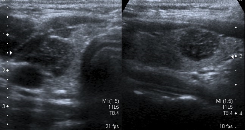 Carcinoma papilar en niño de 9 años. Corte transversal y longitudinal en escala de grises a nivel del lóbulo tiroideo derecho. Se observa imagen nodular hipoecoica con microcalcificaciones y márgenes irregulares