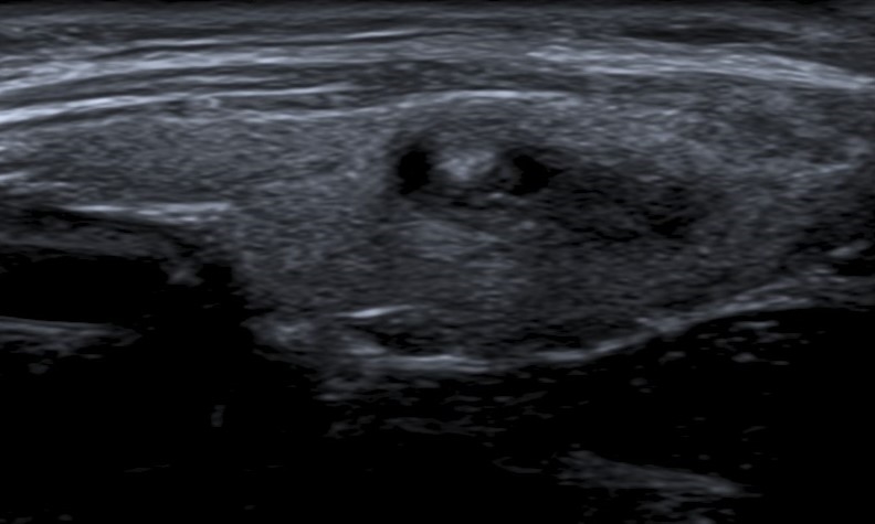 Carcinoma papilar en niña de 9 años. Corte longitudinal en escala de grises del lóbulo tiroideo derecho donde se visualiza imagen nodular heterogénea de predominio hipoecoica de márgenes mal definidos.