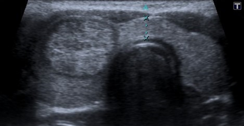 Nódulo adenomatoide en hiperplasia multinodular, en niño de 5 años. Corte transversal en escala de grises a nivel de glándula tiroides. Se evidencia imagen nodular heterogénea hiperecogénica, de márgenes bien delimitados, con halo hipoecoico periférico continuo y bien definido.