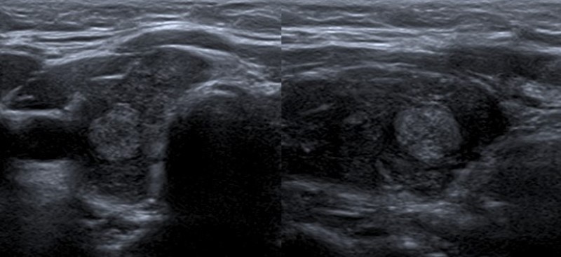 Carcinoma papilar en paciente de 11 años. Cortes transversal y longitudinal en escala de grises de lóbulo tiroideo derecho. Se observa imagen nodular hiperecoica de márgenes lobulados.