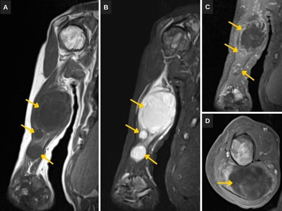 (A) RM de brazo derecho con cortes sagitales T1. (B) Secuencia STIR. (C) Cortes T1 fat sat poscontraste sagital. (D) Corte axial. Se observan los mixomas en el tríceps braquial (flechas), que se ven como masas de baja señal en T1 y alta en STIR, con leve captación periférica del contraste.