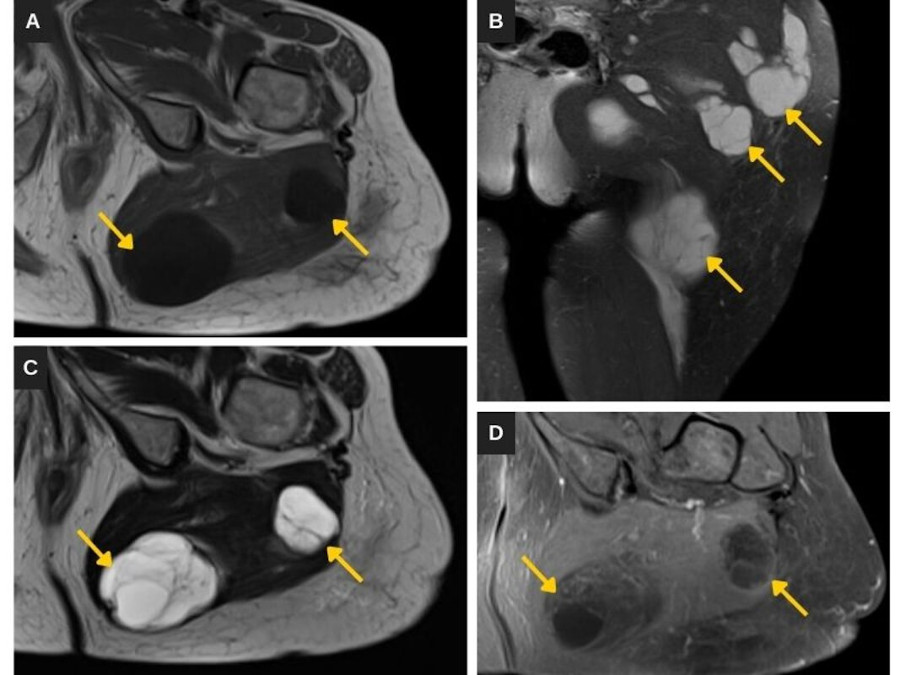 (A) RM de cadera izquierda en corte axial T1. (B) Corte axial T2. (C) Corte coronal STIR. (D) Corte axial T1 fat sat poscontraste. Se ven los mixomas en los músculos glúteos (flechas), que muestran una señal heterogénea, baja en T1 y alta en STIR, con captación periférica del contraste, siendo leve la captación interna.