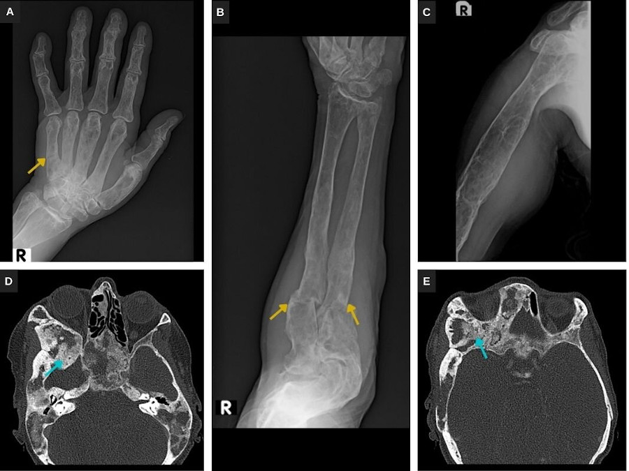 (A) Enfoques radiológicos de frente de mano. (B) Antebrazo. (C) Húmero derecho. La displasia fibrosa (DF) se manifiesta como deformidad ósea, con lesiones medulares expansivas, con densidad mixta, que determinan festoneado endostal. Fracturas patológicas de aspecto evolucionado en quinto metacarpiano, radio y cúbito (flechas). (D y E) Cortes axiales de TC de macizo facial que ponen de manifiesto la densidad en vidrio deslustrado (flechas).