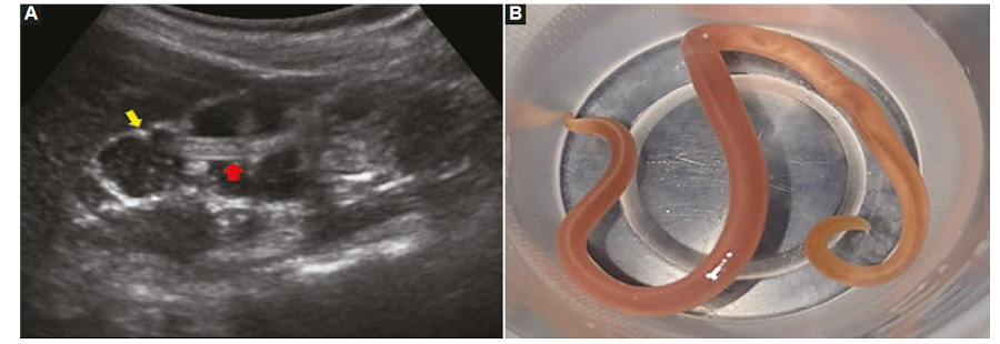 (A) Ecografía abdominal en corte longitudinal donde se observa en el lumen intestinal (flecha amarilla) la conformación del “signo del doble tubo” (flecha roja), en relación con el parásito adulto. (B) Macroscopía de A. lumbricoides, con la que se confirmó el diagnóstico.