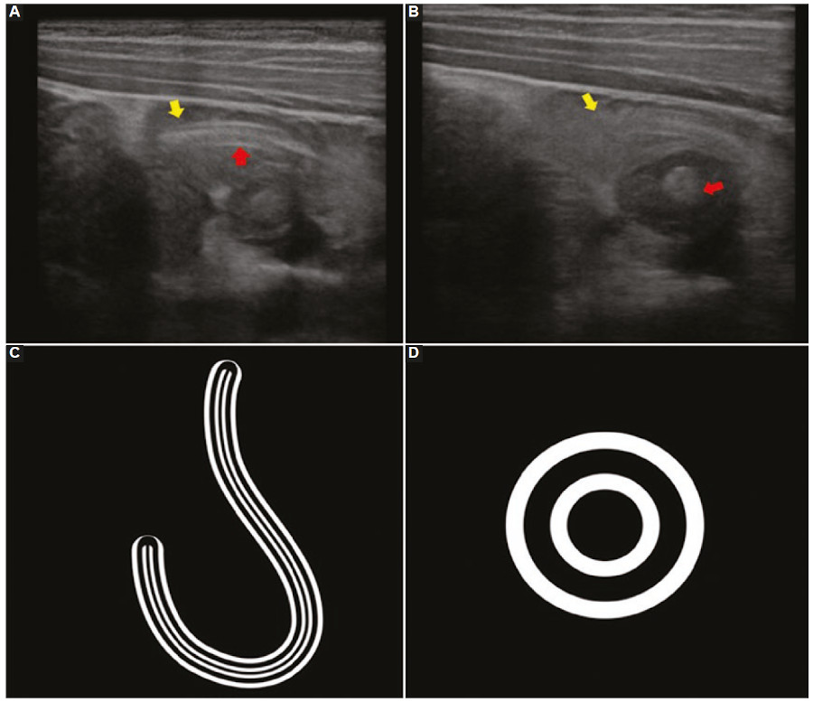 Ecografía abdominal y representaciones gráficas de los signos ecográficos. (A y B) En corte longitudinal y axial, se observa al interior de un asa de intestino delgado (flechas amarillas en A y B) conformando el “signo del doble tubo” (flecha roja en A) y el “signo del ojo de buey” (flecha roja en B). (C y D) Representación gráfica del “signo del doble tubo” (C) y del “signo del ojo de buey” (D), donde las líneas blancas externas representan la superficie externa del áscaris y las otras líneas blancas internas envuelven un centro oscuro relacionado con el tracto gastrointestinal del parásito. El diagnóstico finalmente fue confirmado mediante detección de huevos en heces.