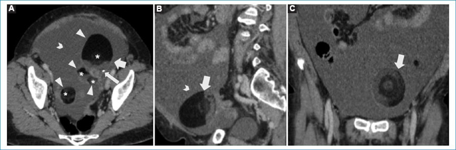 TCMD de pelvis con contraste endovenoso en corte axial (A), sagital (B) y coronal (C) de una paciente de 55 años de edad con dolor y distensión abdominal de aproximadamente un mes de evolución. Se observan múltiples imágenes quísticas mixtas por su componente líquido y graso, de márgenes definidos y con tenue realce tras la administración con contraste endovenoso (cabezas de flecha). Una de ellas presenta nivel líquido-grasa (flecha gruesa), con calcificación puntiforme intratumoral (flecha fina) e imagen nodular central con densidad de partes blandas en relación con nódulo de Rokitansky (asteriscos), hallazgos sugestivos de TQMO. Las lesiones se encuentran rodeadas de líquido (chevrón).
