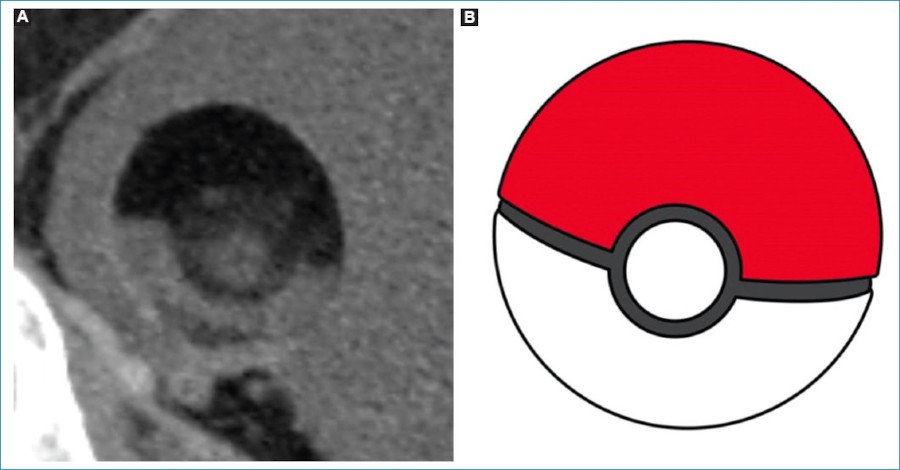 Signo de la Pokebola. (A) TCMD en reconstrucción y rotación 3D de uno de los quistes equivalentes a TQMO descritos y señalados con (flecha gruesa) en la figura 1, observándose el nivel líquido-grasa y el nódulo de Rokitansky central (asteriscos en figura 1) y su respectiva representación gráfica (B).
