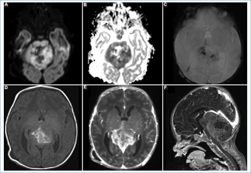 Tumor teratoide rabdoide atpico en un paciente de 1 mes de vida. Lesin expansiva, heterognea, con restriccin de las reas slidas en la secuencia de difusin (A) con representacin en el mapa de ADC (B). En la secuencia de susceptibilidad magntica (C) se observan reas de baja seal que coinciden con reas de alta seal en T1 (D), sugestivo de hemorragia intralesional. Tras la administracin de contraste intravenoso (E y F) se observa realce vvido y heterogneo.