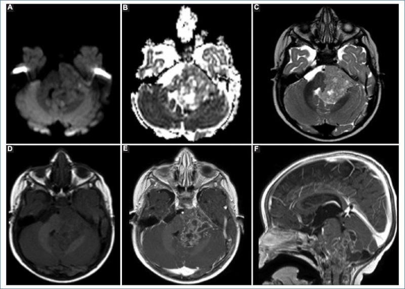 Ependimoma de fosa posterior de grado 3 en un paciente de 11 meses de vida. En las secuencias de difusin (A) y ADC (B) se observa una lesin expansiva en el IV ventrculo, que se extiende hacia posterior, lateral y anterior, sin restriccin. Presenta seal heterognea en la secuencia ponderada en T2 (C) y T1 (D) con restos hemticos y reas qusticas. Tras la administracin de contraste (E) presenta realce heterogneo, principalmente en la porcin slida. En cortes sagitales (F) se observa la extensin de la misma hacia superior e inferior a travs de los formenes de Magendie y Luschka.
