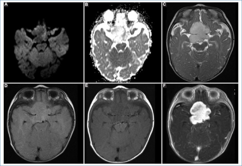Astrocitoma pilomixoide en un paciente de 5 meses de vida. Se observa una imagen selar-supraselar de aspecto polilobulado, sin restriccin en la secuencia de difusin (A) ni cada en el mapa de ADC (B). Presenta seal alta homognea en T2 (C) y FLAIR (D), y baja ponderada en T1 (E). Tras la administracin de contraste intravenoso (F) presenta realce intenso, principalmente homogneo, a excepcin de algunos sectores anteriores y perifricos. Rodea y desplaza las estructuras vasculares.