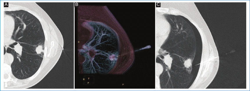 (A) Paciente de 66 a�os con un n�dulo pulmonar perif�rico en el l�bulo superior izquierdo evidenciado por TCMD, sin contacto pleural, aunque con espiculaciones hacia la misma. Se observa abordaje lateral y marcaci�n met�lica sobre la piel para la planificaci�n del trayecto de la aguja. (B) Imagen 3D de TCMD que muestra la aguja coaxial ubicada en la lesi�n y el estilete colocado. (C) Imagen axial de TCMD de control durante el procedimiento, en la que se observan la aguja colocada y la presencia de neumot�rax.