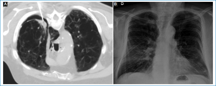 (A) TCMD axial de un paciente de 68 a�os con signos de enfisema confluente/avanzado y n�dulo pulmonar en el �pice pulmonar. Se observan el extremo de la aguja ubicado en el espesor del n�dulo y la presencia de neumot�rax. (B) Radiograf�a de control posterior a la colocaci�n de un tubo de avenamiento pleural, con visualizaci�n del mismo en el campo pulmonar derecho y neumot�rax de grado 1 homolateral, con la opacidad nodular por debajo de la l�nea pleural.