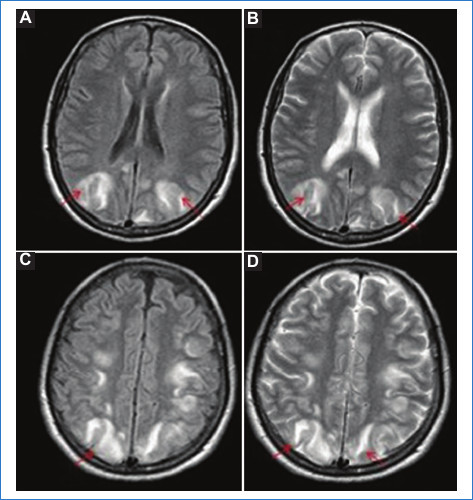 Eclampsia. Cortes axiales de RM en secuencia potenciada para FLAIR (A y C) y T2 (B y D). Se observan �reas hiperintensas cortico-subcorticales parietooccipitales bilaterales y sim�tricas (flechas).