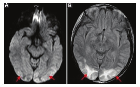 SEPR. Cortes axiales de RM. Se identifica hiperintensidad en difusi�n (A), que se corresponde con hiperintensidad cortico-subcortical parieto-occipital bilateral (flechas) en la secuencia FLAIR (B).
