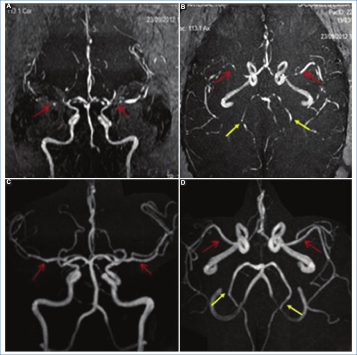 S�ndrome de vasoconstricci�n cerebral reversible. Secuencias de angio-RM intracraneal. (A y B) Se observa estrechamiento de la arteria cerebral media de ambos lados en sus segmentos M1 y M2 (flechas rojas), y en menor medida afectaci�n de las cerebrales posteriores de ambos lados (flechas amarillas). Posterior al tratamiento (C y D) se observan adecuada se�al y calibre del circuito arterial anterior (flechas rojas) y posterior (flechas amarillas).