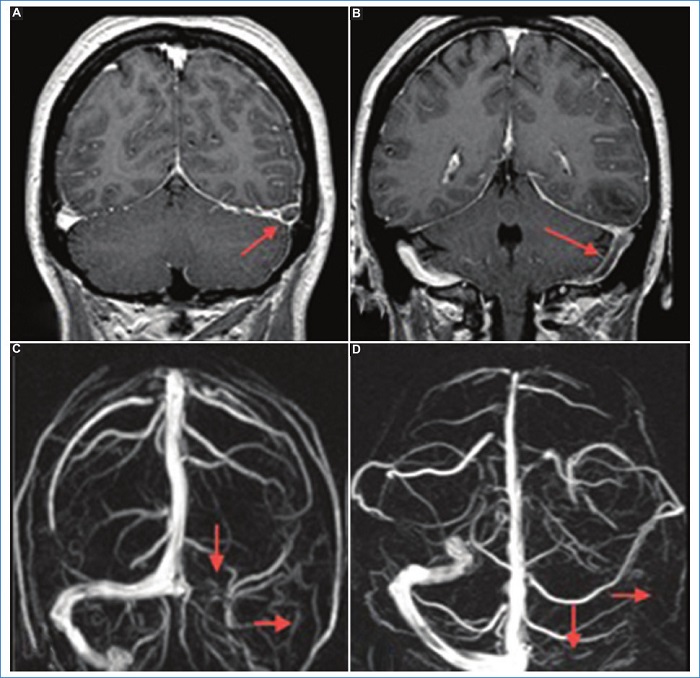 Trombosis venosa cerebral. Cortes coronales de RM en secuencia T1 con gadolinio. A y B: Se identifica un defecto de relleno a nivel del seno venoso transverso del lado izquierdo que se extiende al seno sigmoideo homolateral (flechas). Dichos hallazgos se correlacionan con ausencia de se�al de la estructura mencionada en la reconstrucci�n 3D de la angio-RM venosa (C y D).
