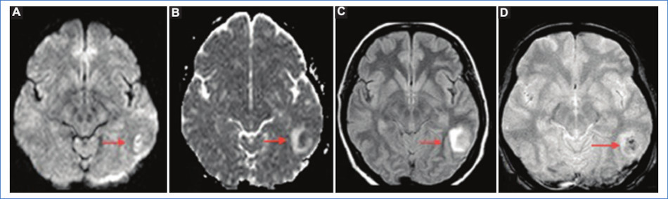 Infarto venoso cerebral. Cortes axiales de RM. A nivel temporoparietal izquierdo (flechas) se identifica un aumento de se�al heterog�nea en la secuencia de difusi�n (A) que se corresponde con una leve hipointensidad en el mapa de ADC con halo hiperintenso (B). Dichos hallazgos son visibles en FLAIR (C) y en secuencia FFE (D), mencionando en esta �ltima algunas �reas hipointensas en su interior vinculadas a �reas de sangrado.