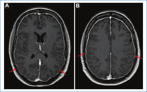 Cefalea pospunci�n. Cortes axiales de RM a nivel de los ventr�culos laterales (A) y los centros semiovales (B), secuencia ponderada en T1 con gadolinio. Las flechas se�alan un ligero engrosamiento y realce paquimen�ngeo.