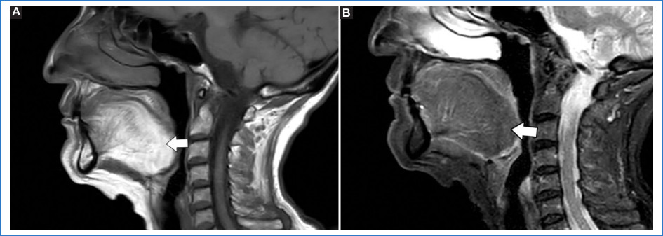 Plano sagital de RM de la cavidad oral ponderados en secuencias ponderadas en T1 (A) y STIR (B). La lengua se aprecia hiperintensa en T1 (flecha), originando el &ldquo;signo de la lengua brillante&rdquo;, como consecuencia de la infiltraci�n grasa. En STIR esta se observa hipointensa (flecha).