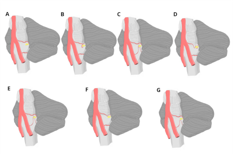 Complejos neurovasculares y variantes anatómicas. (A) Complejo neurovascular normal. (B)Loop completo de la AICA, con recorrido de 360° hasta el nervio. (C)Loop completo de la ACPI, con recorrido de 360° hasta el nervio. (D)Loop incompleto de la AICA con recorrido de 180°. (E)Loop incompleto de la ACPI con recorrido de 180°. (F)Loop tangencial de la AICA. (G)Loop tangencial de la ACPI.