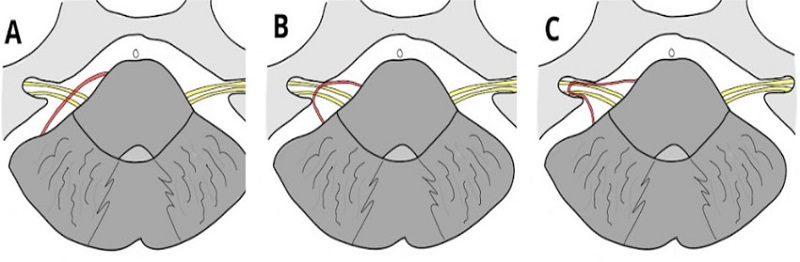 Clasificación anatómica Chavda. (A) Tipo I loop vascular en el ángulo pontocerebeloso, que no ingresa al CAI. (B) Tipo II loop vascular ingresa, sin extensión > 50% del CAI. (C) Tipo III loop vascular con extensión > 50% del CAI.