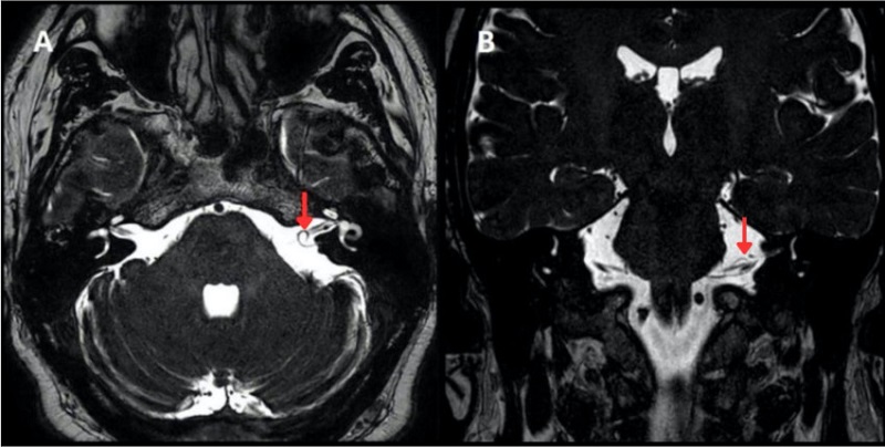 (A) Corte axial. (B) Corte coronal, loop vascular completo de tipo I de la AICA del oído izquierdo (flechas).