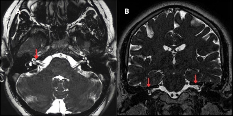 (A) Corte axial. (B) Corte coronal, loop vascular completo bilateral de tipo III de la AICA (flechas).