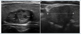 Ecograf�a, planos axiales NT confirmados por biopsia. (A) NT benigno (s�lido, isoecoico, m�s ancho que alto sin microcalcificaciones). (B) NT maligno (c�ncer papilar de tiroides) s�lido, hipoecoico de bordes irregulares.