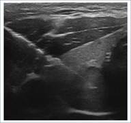 Ecograf�a, plano axial. Biopsia de n�dulo tiroideo por aguja fina.