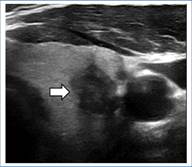 Ecograf�a, plano axial NT hipoecoico (flecha blanca).