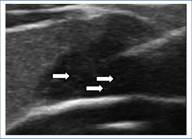 Ecograf�a, plano axial. NT con microcalcificaciones (flechas blancas).