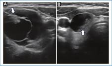 Ecograf�a, planos axiales. A y B: NT predominantemente qu�sticos con componente s�lido sospechoso (flechas blancas).