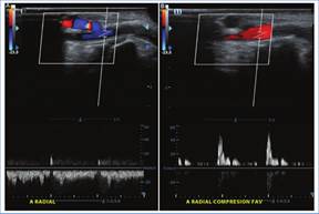 Paciente con f�stula radiocef�lica. En la evaluaci�n de la arteria radial distal se evidencia flujo invertido en di�stole (A), con restablecimiento del flujo anter�grado luego de la compresi�n manual de la FAV (B); hallazgos compatibles con robo arterial.