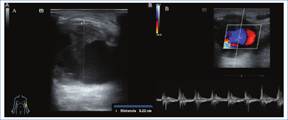Paciente con f�stula radiocef�lica. Se observa dilataci�n aneurism�tica en la vena eferente, con contenido ecog�nico endoluminal compatible con trombosis parcial (A). En la evaluaci�n Doppler color se evidencia imagen en doble color (B).