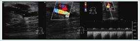 Paciente con f�stula prot�sica de hemodi�lisis. Se visualiza una soluci�n de continuidad de la pr�tesis en comunicaci�n con una colecci�n l�quida que muestra flujo turbulento en la evaluaci�n Doppler y espectral; hallazgo compatible con pseudoaneurisma.