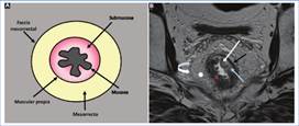 Anatomía del recto. A: Representación gráfica de un corte axial de recto donde se pueden visualizar las diferentes estructuras anatómicas que lo componen. B: Corte axial oblicuo de recto medio potenciado en secuencia T2, donde se pueden visualizar las diferentes estructuras anatómicas de la región: FMR (flecha curva), mesorrecto (estrella blanca) y las diferentes capas de la pared rectal: muscular propia (flecha negra), submucosa (flecha celeste) y mucosa (flecha blanca). Además, se puede identificar una lesión tumoral (cruz roja) que compromete las tres capas de la pared rectal, alcanzando al mesorrecto.