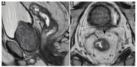 Estadio tumoral T4a. A: Imagen en el plano sagital potenciada en T2 de paciente con tumor de recto medio y superior, observándose compromiso de la pared rectal adyacente a la reflexión peritoneal, generando una mínima retracción de esta (flecha negra). B: Imagen axial oblicua, perpendicular al eje longitudinal tumoral y potenciada en T2 del mismo paciente, donde se visualiza un engrosamiento de la pared rectal que compromete a la reflexión peritoneal anterior (flecha negra). La punta de flecha indica una porción distal de la reflexión peritoneal anterior.
