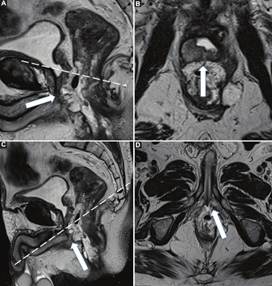 Estadio tumoral T4b. A y B: Imágenes potenciadas en T2 obtenidas en los planos sagital y axial oblicuo (angulada en forma perpendicular al eje longitudinal de la lesión), donde se constata un tumor de recto que se extiende desde el canal anal hasta recto superior. Se identifica como la lesión tumoral se encuentra en íntimo contacto con la próstata y la base del pene (flecha blanca). C y D: Imágenes potenciadas en T2 obtenidas en los planos sagital y axial oblicuo (angulada en forma perpendicular al canal anal) del mismo paciente donde se identifica el compromiso de la base del pene (flecha blanca). Nótese cómo la realización de dos angulaciones axiales oblicuas, una siguiendo el eje longitudinal del tumor en el recto medio y otra siguiendo el eje longitudinal del canal anal, permitió la correcta determinación del compromiso de las estructuras vecinas.