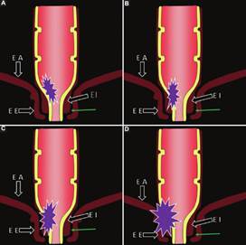 Representación gráfica de los diferentes estadios de compromiso del canal anal. A: Estadio 1: el tumor se limita a la pared rectal. B: Estadio 2: el tumor se extiende comprometiendo la capa muscular del esfínter interno (EI). C: Estadio 3: el tumor invade el espacio interesfinteriano (flecha verde) y se encuentra a 1 mm o menos del músculo elevador del ano (EA). D: Estadio 4: el tumor invade al esfínter anal externo (EE) y se encuentra a menos de 1 mm o incluso más allá del EA, independientemente de si existe o no invasión de órganos vecinos.
