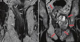 Ejemplos de diferentes grados de compromiso del canal anal. A: Imagen potenciada en T2 obtenida en el plano coronal siguiendo el eje coronal del canal anal, de un paciente con un tumor que afecta al recto medio e inferior (flechas blancas), el cual se encuentra limitado a la pared rectal, sin compromiso del complejo esfinteriano, correspondiendo a un estadio 1. B: En este otro caso se muestra un paciente con un tumor que afecta al recto inferior, medio y superior, que invade todas las estructuras del complejo esfinteriano (flechas rojas), correspondiendo a un estadio 4.