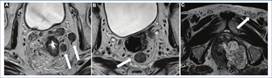 Compromiso ganglionar. A y B: Imágenes potenciadas en T2 obtenidas en el plano axial oblicuo perpendiculares al eje longitudinal del tumor de un mismo paciente, en diferentes niveles, donde se observan estructuras ganglionares que adquieren forma redondeada, de aspecto levemente heterogéneo y de un diámetro superior a 9 mm (flechas blancas) en su eje menor compatibles con adenopatías mesorrectales. C: Imagen potenciada en T2 axial oblicua obtenida en forma perpendicular al eje longitudinal del canal anal, donde se observa una estructura ganglionar de forma redondeada y con un diámetro superior a 9 mm (flecha blanca).