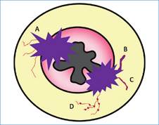 Representación gráfica de los diferentes tipos de IVEM. A; Vasos de calibre normal y sin cambios en su intensidad de señal, ubicados próximos al tumor. B: Vasos dilatados con cambios en su intensidad de señal interna. C: Vasos de calibre normal, pero con alteración de su intensidad de señal.