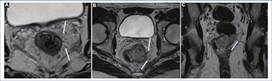 Ejemplos de IVEM. A: Imagen potenciada en T2 obtenida en el plano axial oblicuo perpendicular al eje longitudinal tumoral, donde se observan estructuras vasculares de calibre conservado (flechas blancas). B y C: Imágenes potenciadas en T2 axial oblicuo y coronal longitudinal al canal anal, donde se constatan estructuras vasculares levemente engrosadas, con cambios en su intensidad de señal (flechas blancas) compatibles con IVEM. D: Vasos irregulares con dilataciones nodulares, secundarias a la presencia tumoral.