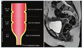 Anatomía topográfica del recto. A: Representación gráfica de la anatomía topográfica del recto teniendo en cuenta como referencia la distancia al margen anal. B: Imagen en el plano sagital potenciada en T2 del recto. Las líneas de trazo marcan las divisiones entre recto inferior (RI), recto medio (RM), recto superior (RS) y colon sigmoides (CS) teniendo en cuenta la distancia al margen anal (flecha blanca).