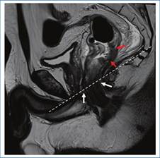Anillo puborrectal. Imagen obtenida en el plano sagital y potenciada en secuencia T2 de recto. La línea de trazo se extiende desde la cara inferior del pubis hacia la cara inferior del sacro, sirviendo de referencia para la ubicación del anillo puborrectal (flechas blancas). Además, se identifica una lesión tumoral que compromete la pared posterior del recto medio (flechas rojas).