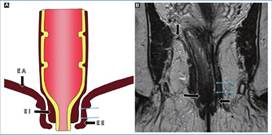 Complejo del esfínter anal. A: Representación esquemática de las estructuras que componen al esfínter anal. B: Imagen obtenida en el plano coronal y potenciada en secuencia T2, angulada sobre el canal anal, donde se puede observar: el músculo elevador del ano (EA), el esfínter interno (EI), el esfínter externo (EE) y el espacio interesfinteriano (flechas celestes).