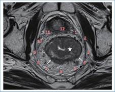 Ubicación de las lesiones por el método del reloj. Imagen axial oblicua obtenida perpendicular al eje longitudinal tumoral, potenciada en T2, a nivel del recto medio. Se identifica una lesión tumoral con compromiso circunferencial del recto (estrella blanca). Siguiendo el método de ubicación según el reloj, se puede describir que el tumor se extiende más allá de la muscular propia entre la hora 4 (H4) y la hora 7 (H7) (flechas blancas). A nivel del mesorrecto se visualiza también una imagen ganglionar (punta de flecha). En este caso, el tumor fue estadificado como T3c, debido a que presenta una extensión de aproximadamente 6 mm hacia el mesorrecto.