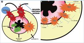 Representación gráfica de la estadificación T. A: Representación esquemática de los diferentes estadios de T. Se puede observar cómo los estadios T1 y T2 se limitan a la pared intestinal, no extendiéndose más allá de la muscular propia. El estadio T3 se extiende más allá de la pared intestinal y alcanza el mesorrecto mientras que el estadio T4a compromete la reflexión peritoneal anterior y el T4b a órganos vecinos. B: Se observa la diferente subclasificación del estadio T3. Las flechas celestes indican de qué forma debe medirse la extensión de la invasión, midiendo desde la muscular propia hasta la mayor distancia alcanzada por el tumor (línea de trazo). Los valores expresados en milímetros (mm) son el nivel de extensión tumoral correspondiente a cada subestadio.