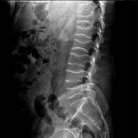 Radiograf�a lateral de paciente var�n de 34 a�os con diagn�stico de p�rpura trombocitop�nica idiop�tica, con severa osteoporosis inducida por glucocorticoides, evidenci�ndose el signo de la v�rtebra de pescado (archivo original del Centro Radiol�gico DMI, Chiclayo, Per�).